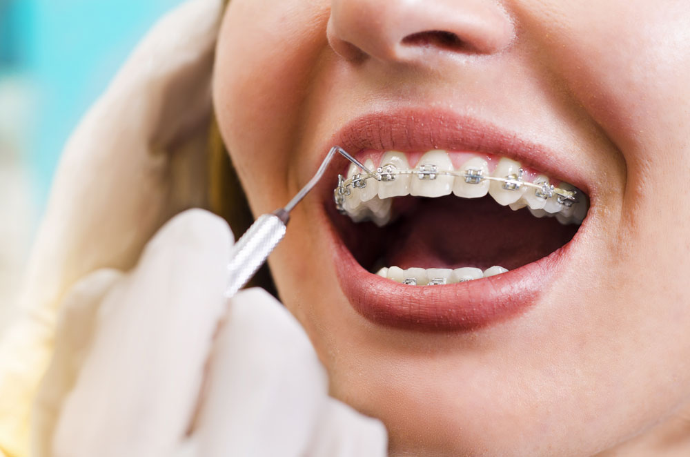 Neden ortodontik tedavi olmalıyım?